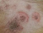 真菌感染皮肤病图片,真菌感染皮肤病：症状、治疗方法及预防措施